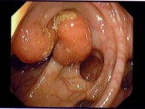 Tumore al colon endoscopia