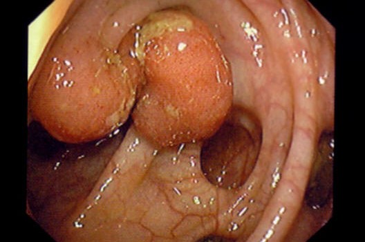 Tumore al colon endoscopia